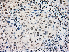 GCK / Glucokinase Antibody - IHC of paraffin-embedded Adenocarcinoma of breast tissue using anti-GCK mouse monoclonal antibody. (Dilution 1:50).