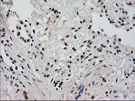 GCK / Glucokinase Antibody - IHC of paraffin-embedded Carcinoma of lung tissue using anti-GCK mouse monoclonal antibody. (Dilution 1:50).