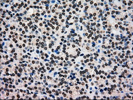 GCK / Glucokinase Antibody - IHC of paraffin-embedded Carcinoma of thyroid tissue using anti-GCK mouse monoclonal antibody. (Dilution 1:50).