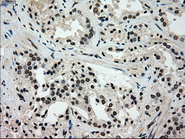 GCK / Glucokinase Antibody - IHC of paraffin-embedded Carcinoma of prostate tissue using anti-GCK mouse monoclonal antibody. (Dilution 1:50).