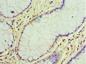 GCKR Antibody - Immunohistochemistry of paraffin-embedded human colon cancer using antibody at 1:100 dilution.  This image was taken for the unconjugated form of this product. Other forms have not been tested.