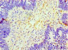 GCKR Antibody - Immunohistochemistry of paraffin-embedded human ovarian cancer using antibody at 1:100 dilution.  This image was taken for the unconjugated form of this product. Other forms have not been tested.