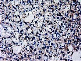 GCKR Antibody - Immunohistochemical staining of paraffin-embedded Carcinoma of Human kidney tissue using anti-GCKR mouse monoclonal antibody. (Heat-induced epitope retrieval by 10mM citric buffer, pH6.0, 100C for 10min,