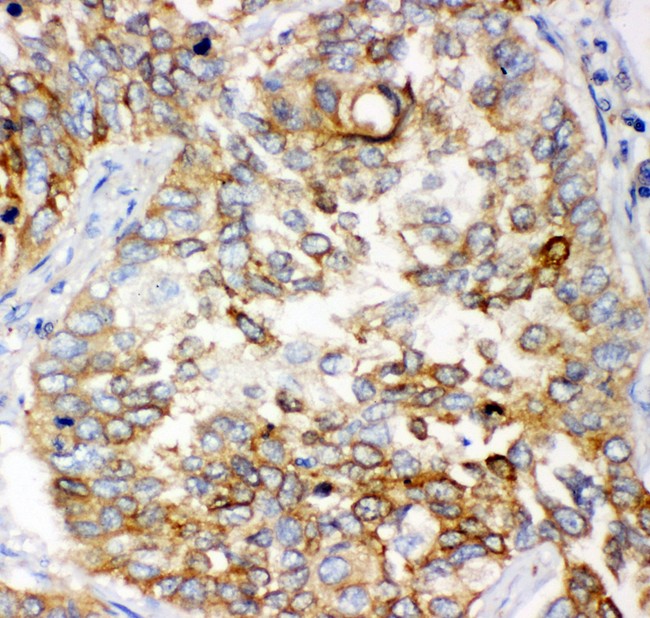 GCLC Antibody - GCLC antibody IHC-paraffin: Human Lung Cancer Tissue.