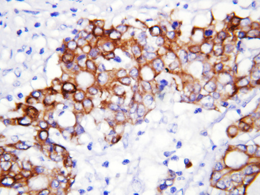 GCLC Antibody - GCLC antibody. IHC(P): Human Rectal Cancer Tissue.