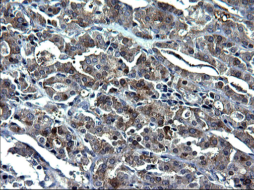 GCLC Antibody - IHC of paraffin-embedded Carcinoma of Human thyroid tissue using anti-GCLC mouse monoclonal antibody. (Heat-induced epitope retrieval by 1 mM EDTA in 10mM Tris, pH8.5, 120°C for 3min).
