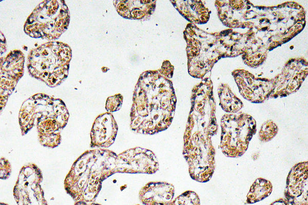GCLM Antibody - Immunohistochemistry analysis of GCSm-Î³ antibody in paraffin-embedded human prostate carcinoma tissue.