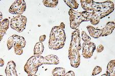 GCLM Antibody - Immunohistochemistry analysis of GCSm-Î³ antibody in paraffin-embedded human prostate carcinoma tissue.