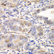 GCLM Antibody - Immunohistochemistry of paraffin-embedded human gastric cancer tissue.