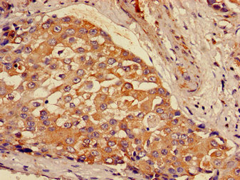 GCLM Antibody - Immunohistochemistry image of paraffin-embedded human breast cancer at a dilution of 1:100
