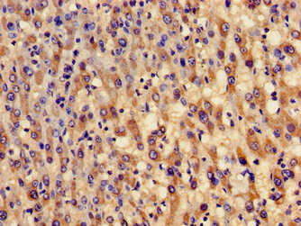 GCLM Antibody - Immunohistochemistry image of paraffin-embedded human liver cancer at a dilution of 1:100