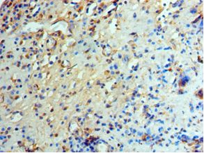 GCN2 Antibody - Immunohistochemistry of paraffin-embedded human prostatic cancer using antibody at 1:100 dilution.
