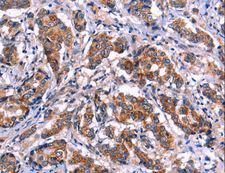 GCN2 Antibody - Immunohistochemistry of paraffin-embedded Human liver cancer using EIF2AK4 Polyclonal Antibody at dilution of 1:50.