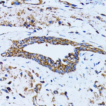 GCN2 Antibody - Immunohistochemistry of paraffin-embedded human breast cancer using EIF2AK4 antibody at dilution of 1:100 (40x lens).