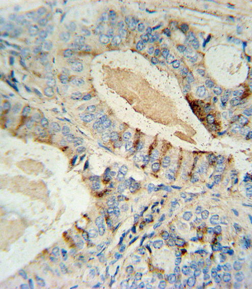 GCNT2 Antibody - GCNT2 antibody immunohistochemistry of formalin-fixed and paraffin-embedded human prostate carcinoma followed by peroxidase-conjugated secondary antibody and DAB staining.