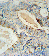 GCNT2 Antibody - GCNT2 antibody immunohistochemistry of formalin-fixed and paraffin-embedded human prostate carcinoma followed by peroxidase-conjugated secondary antibody and DAB staining.