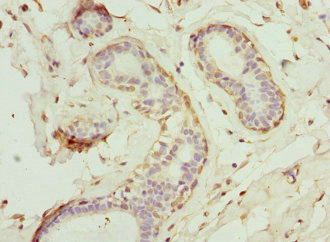 GCNT2 Antibody - Immunohistochemistry of paraffin-embedded human breast cancer at dilution 1:100