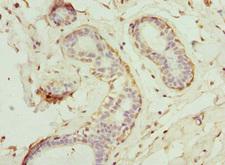GCNT2 Antibody - Immunohistochemistry of paraffin-embedded human breast cancer at dilution 1:100