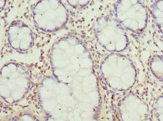 GCNT2 Antibody - Immunohistochemistry of paraffin-embedded human colon cancer at dilution 1:100