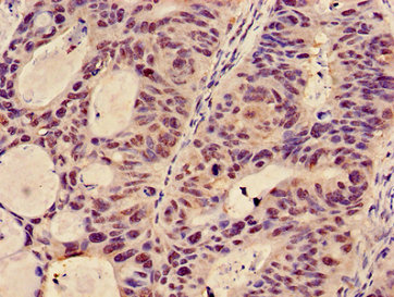GCNT3 Antibody - Immunohistochemistry image of paraffin-embedded human colon cancer at a dilution of 1:100