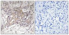 GCNT3 Antibody - Peptide - + Immunohistochemistry analysis of paraffin-embedded human liver carcinoma tissue using GCNT3 antibody.