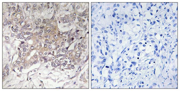GCNT3 Antibody - Peptide - + Immunohistochemistry analysis of paraffin-embedded human liver carcinoma tissue using GCNT3 antibody.