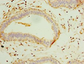 GCP3 / TUBGCP3 Antibody - Immunohistochemistry of paraffin-embedded human breast cancer using antibody at 1:100 dilution.