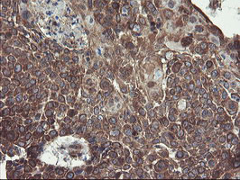 GCP60 / ACBD3 Antibody - IHC of paraffin-embedded Carcinoma of Human lung tissue using anti-ACBD3 mouse monoclonal antibody.