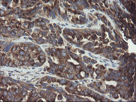 GCP60 / ACBD3 Antibody - IHC of paraffin-embedded Adenocarcinoma of Human ovary tissue using anti-ACBD3 mouse monoclonal antibody.