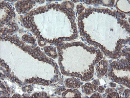 GCP60 / ACBD3 Antibody - IHC of paraffin-embedded Carcinoma of Human thyroid tissue using anti-ACBD3 mouse monoclonal antibody.