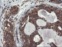 GCP60 / ACBD3 Antibody - IHC of paraffin-embedded Adenocarcinoma of Human breast tissue using anti-ACBD3 mouse monoclonal antibody.