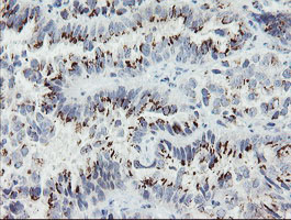 GCP60 / ACBD3 Antibody - IHC of paraffin-embedded Adenocarcinoma of Human ovary tissue using anti-ACBD3 mouse monoclonal antibody. (Heat-induced epitope retrieval by 10mM citric buffer, pH6.0, 100C for 10min).