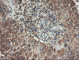 GCP60 / ACBD3 Antibody - IHC of paraffin-embedded Carcinoma of Human lung tissue using anti-ACBD3 mouse monoclonal antibody.