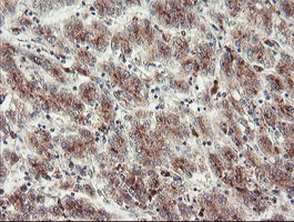 GCP60 / ACBD3 Antibody - IHC of paraffin-embedded Carcinoma of Human liver tissue using anti-ACBD3 mouse monoclonal antibody.