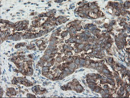 GCP60 / ACBD3 Antibody - IHC of paraffin-embedded Adenocarcinoma of Human ovary tissue using anti-ACBD3 mouse monoclonal antibody.