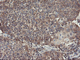 GCP60 / ACBD3 Antibody - IHC of paraffin-embedded Carcinoma of Human bladder tissue using anti-ACBD3 mouse monoclonal antibody.
