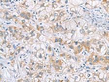 GCSH Antibody - Immunohistochemistry of paraffin-embedded Human liver cancer tissue  using GCSH Polyclonal Antibody at dilution of 1:60(×200)