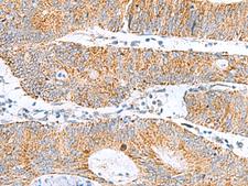 GCSH Antibody - Immunohistochemistry of paraffin-embedded Human colorectal cancer tissue  using GCSH Polyclonal Antibody at dilution of 1:60(×200)