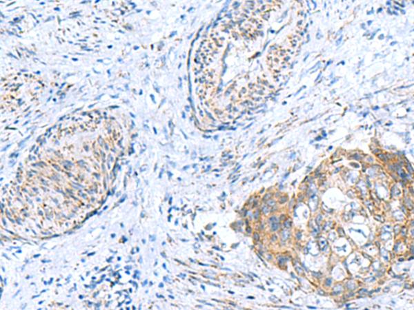 GCSH Antibody - Immunohistochemistry of paraffin-embedded Human cervical cancer tissue  using GCSH Polyclonal Antibody at dilution of 1:60(×200)
