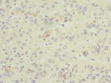 GDAP1 Antibody - Immunohistochemistry of paraffin-embedded human liver cancer tissue at dilution 1:100