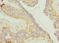 GDAP1 Antibody - Immunohistochemistry of paraffin-embedded human breast cancer tissue at dilution 1:100