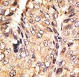 GDF10 / BMP3B Antibody - Formalin-fixed and paraffin-embedded human cancer tissue reacted with the primary antibody, which was peroxidase-conjugated to the secondary antibody, followed by DAB staining. This data demonstrates the use of this antibody for immunohistochemistry; clinical relevance has not been evaluated. BC = breast carcinoma; HC = hepatocarcinoma.