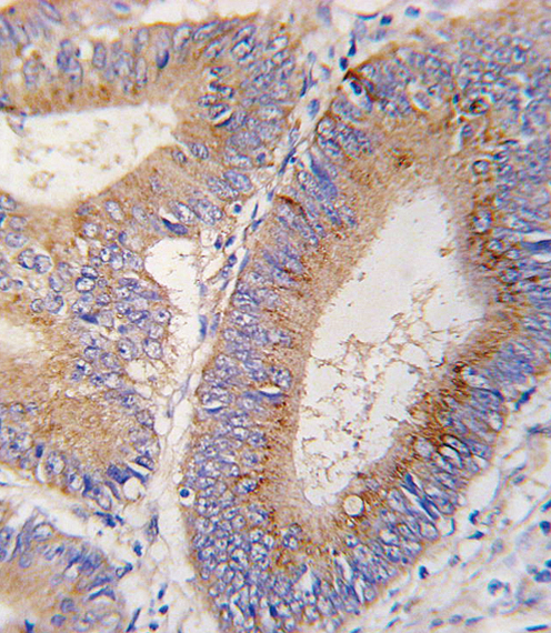 GDF11 / GDF-11 Antibody - Formalin-fixed and paraffin-embedded human colon carcinoma tissue reacted with GDF11 antibody , which was peroxidase-conjugated to the secondary antibody, followed by DAB staining. This data demonstrates the use of this antibody for immunohistochemistry; clinical relevance has not been evaluated.