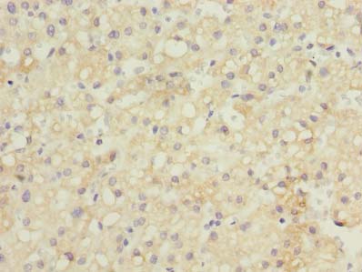 GDF2 / BMP9 Antibody - Immunohistochemistry of paraffin-embedded human liver cancer using antibody at dilution of 1:100.