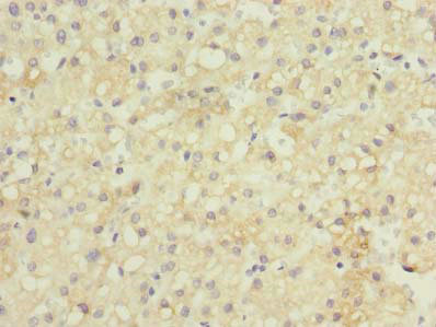 GDF2 / BMP9 Antibody - Immunohistochemistry of paraffin-embedded human liver cancer using GDF2 Antibody at dilution of 1:100