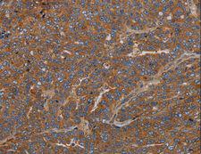 GDF2 / BMP9 Antibody - Immunohistochemistry of paraffin-embedded Human ovarian cancer using GDF2 Polyclonal Antibody at dilution of 1:40.