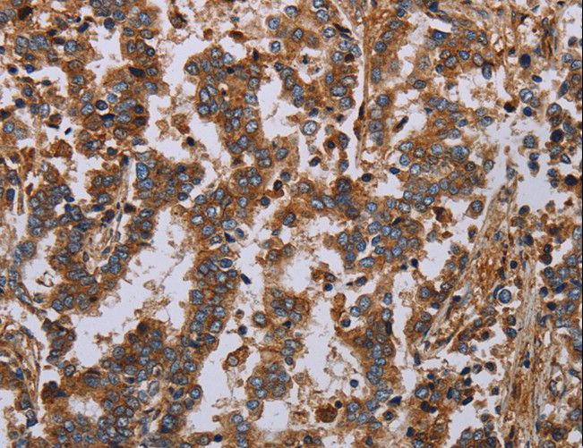 GDF2 / BMP9 Antibody - Immunohistochemistry of paraffin-embedded Human liver cancer using GDF2 Polyclonal Antibody at dilution of 1:40.