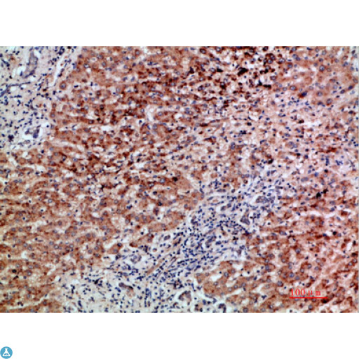 GDF2 / BMP9 Antibody - Immunohistochemical analysis of paraffin-embedded human-liver-cancer, antibody was diluted at 1:200.