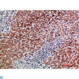 GDF2 / BMP9 Antibody - Immunohistochemical analysis of paraffin-embedded human-liver-cancer, antibody was diluted at 1:200.
