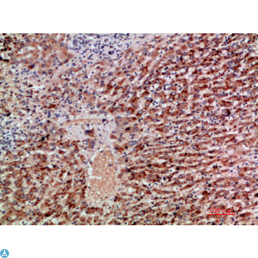 GDF2 / BMP9 Antibody - Immunohistochemical analysis of paraffin-embedded human-liver-cancer, antibody was diluted at 1:200.